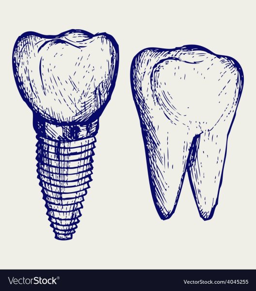 Имплант рисунок