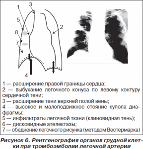 Обеднение легочного рисунка (50 фото)