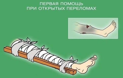 ПМП при открытых переломах
