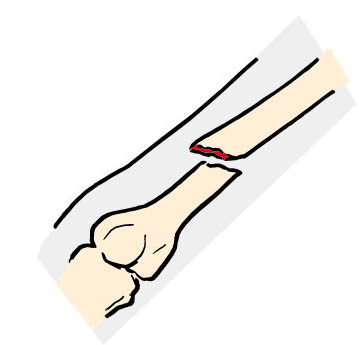 Открытый перелом руки открытый перелом