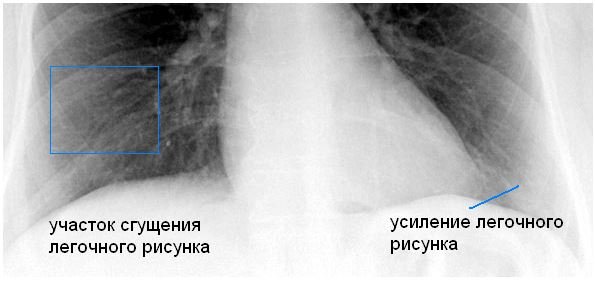 Усиление легочного рисунка