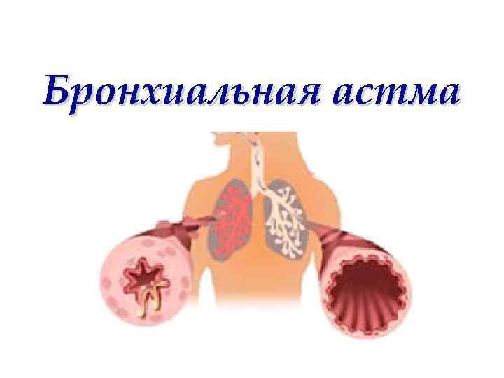 Bronchial asthma. Бронхиальная астма. Бронхиальная астма презентация. Презентация по теме бронхиальная астма. Бронхиальная астма картинки.