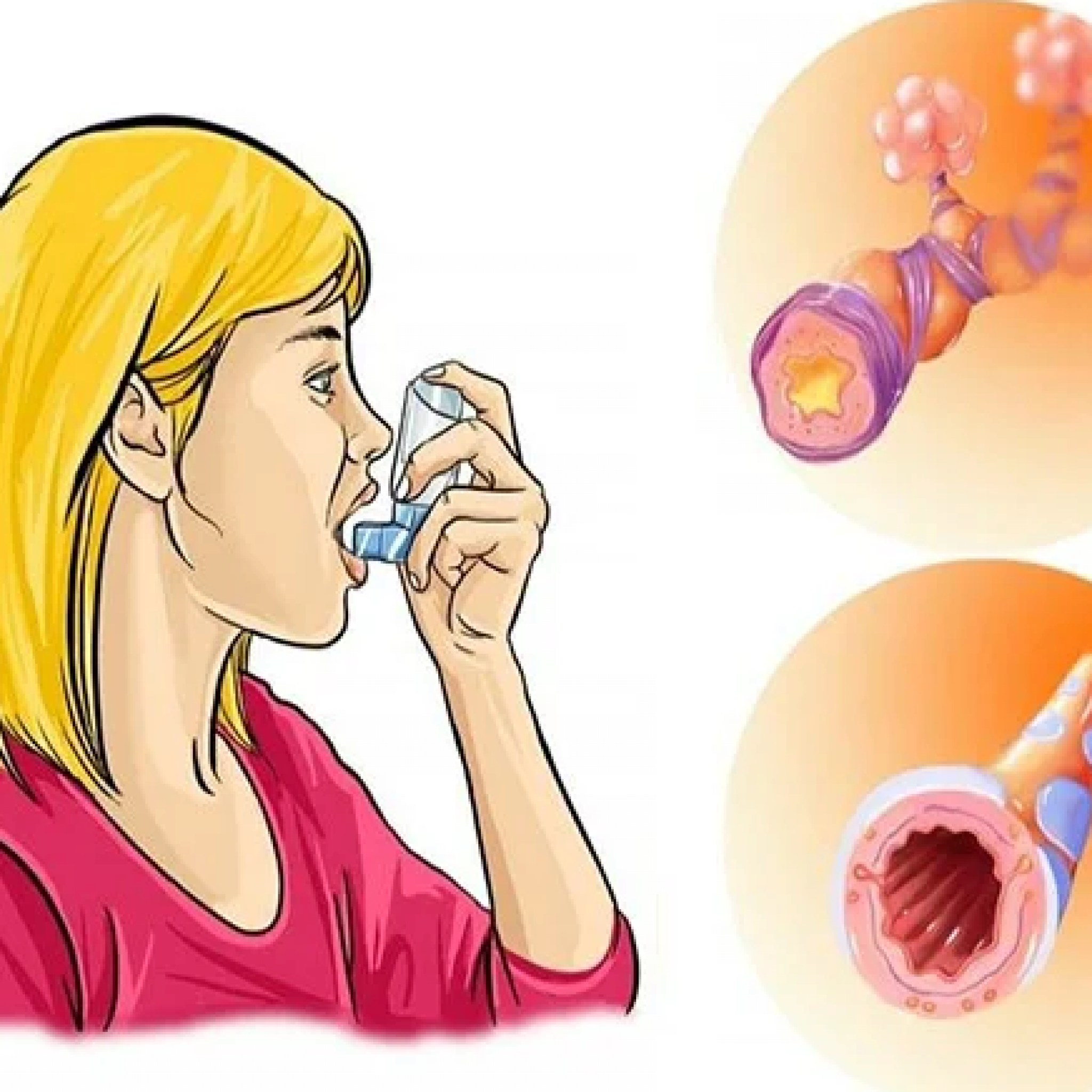 Астма заболевание дыхательных. Бронхиальная астма. Приступ астмы. Бронхиальная астма картинки. Беременные с бронхиальной астмой.