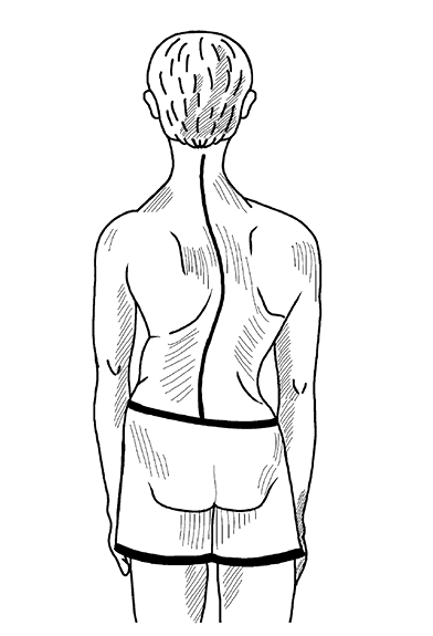 Сколиоз рисунок