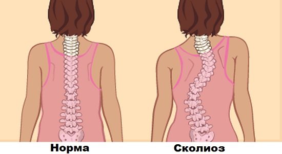 Нормальное искривление позвоночника