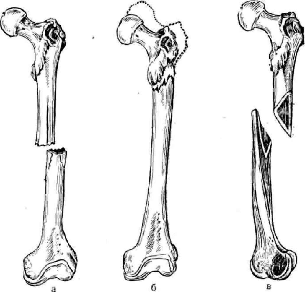 Переломы скелета