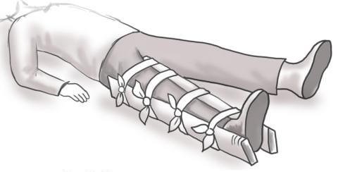 Открытый перелом нижней конечности