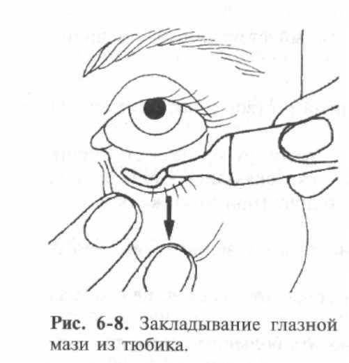 Закладывание мази в конъюнктивальный мешок