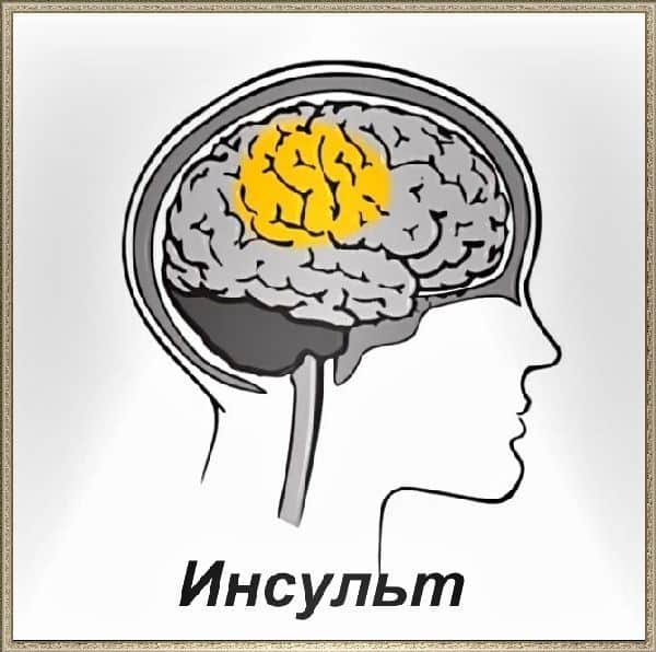 Инсульт чб