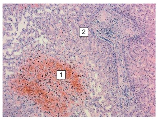 Мускатная печень макропрепарат