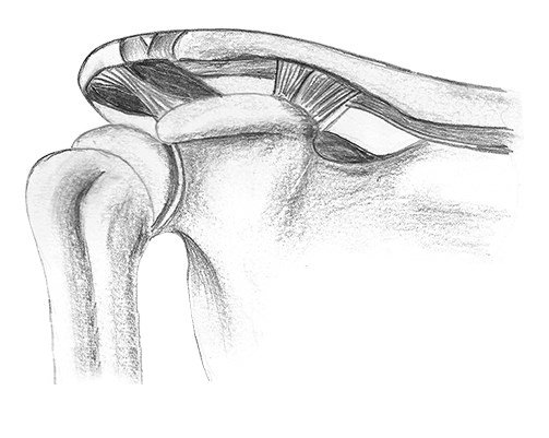 Дисторсия плечевого сустава