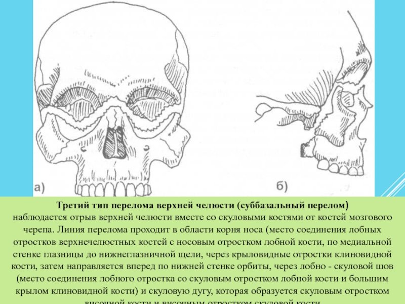 Перелом лицевого черепа. Скуловая кость черепа анатомия. Перелом верхней челюсти кт. Скуловая дуга анатомия. Перелом лобного отростка верхней челюсти кт.