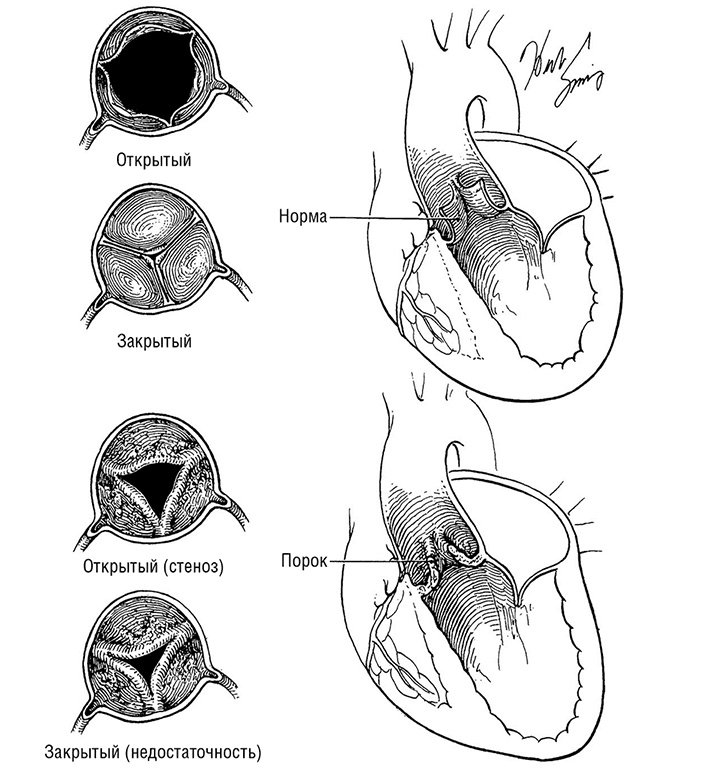 Митральный аортальный стеноз. Митральный клапан и аортальный клапан. Аортальный клапан и митральный клапа. Порок митрального клапана сердца. Порок аортального клапана сердца.