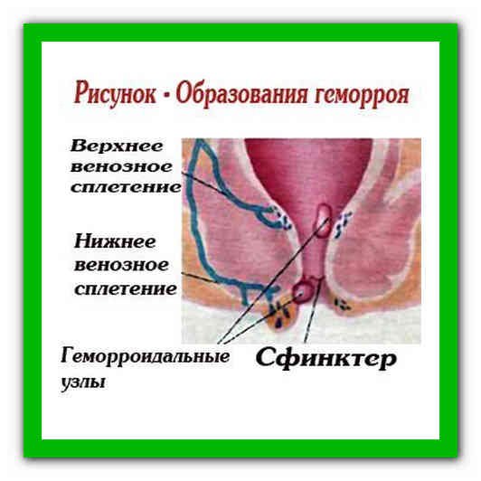 Внешний геморрой анатомия