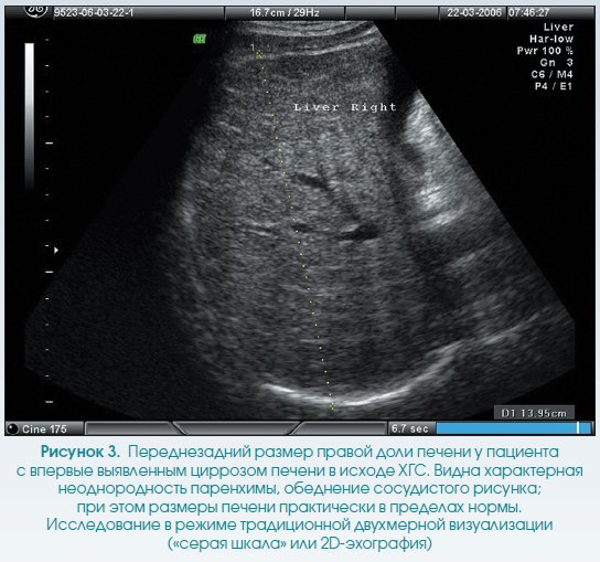 Усиление сосудистого рисунка печени