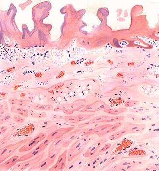 Фибринозный перикардит гистология