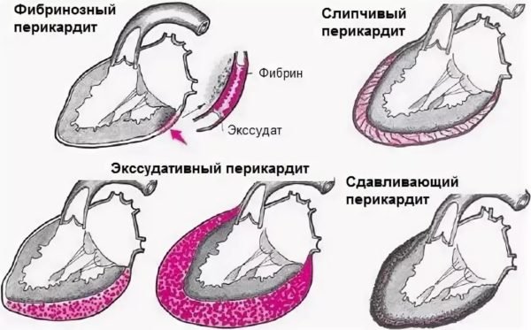 Адгезивный слипчивый перикардит