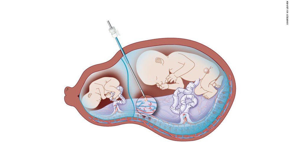 Фетальная хирургия. Редукция эмбриона при многоплодной беременности. Рисунок художника плацента. Селективная редукция одного плода из двойни.