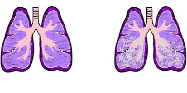 Стадии отека легких