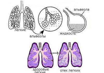 Симптомы отёка лёгких у детей