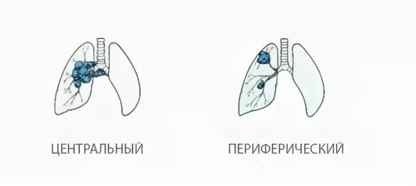 Центральные опухоли легкого и периферические