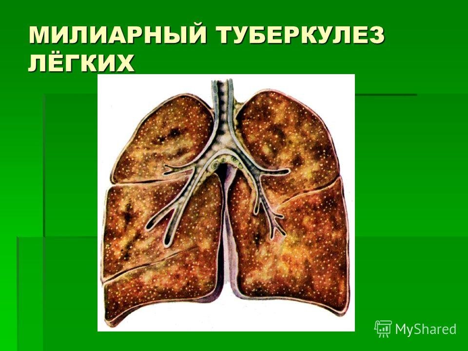 Туберкулез образ жизни. Милиарный диссеминированный туберкулез. Милиарный и очаговый туберкулез. Милиарный туберкулез легких. Миллиардный туберкулещ оешких.
