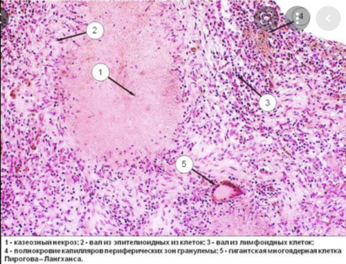 Туберкулезная гранулема микропрепарат