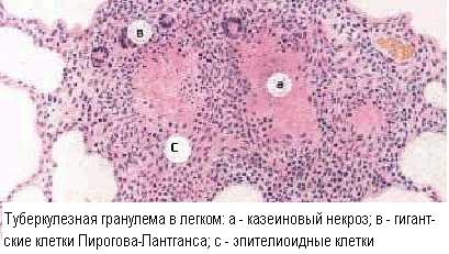 Туберкулезные бугорки в легком рисунки (50 фото)