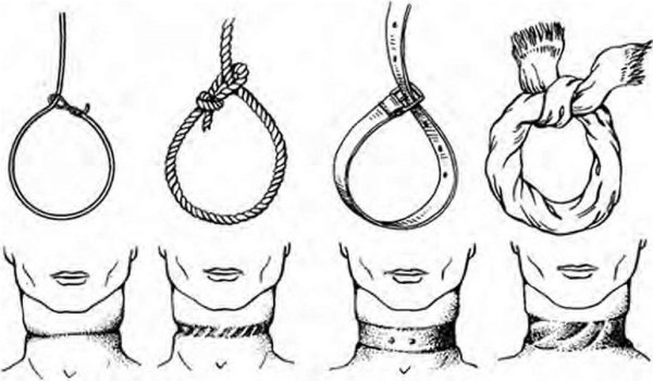 Странгуляционная борозда схема