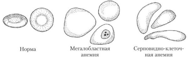 Мегалобластные формы эритроцитов