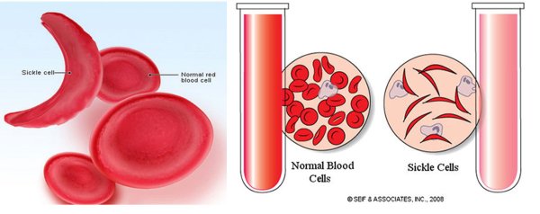 Воспалительная реакция ++, эритроциты