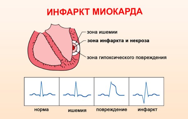 Форма сердца при инфаркте миокарда