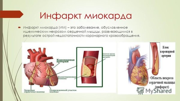 Некроз при инфаркте миокарда