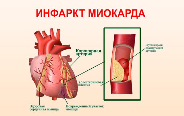 Инфаркт миокарда картинки