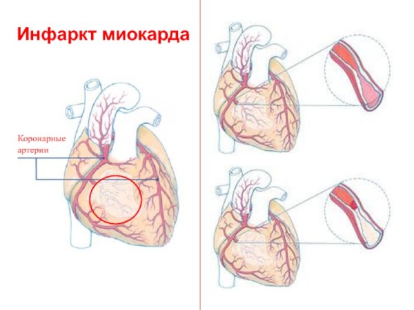 Коронарная артерия инфаркт миокарда