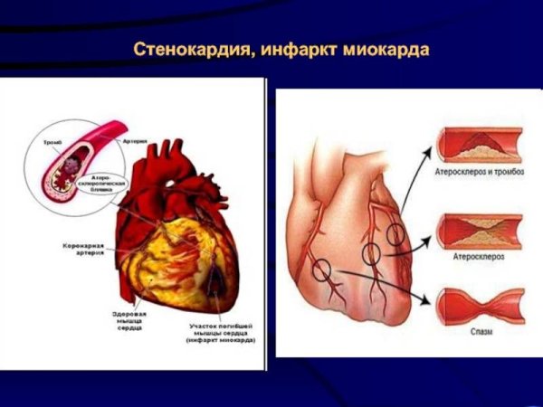 Симптомы стенокардии и инфаркта миокарда