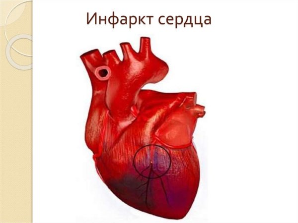Сердце человека инфаркт миокарда