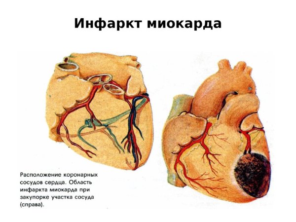 Влияние алкоголя на сердечно-сосудистую систему