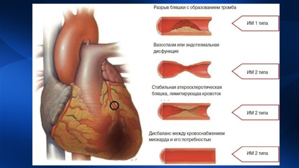 Форма сердца при инфаркте миокарда
