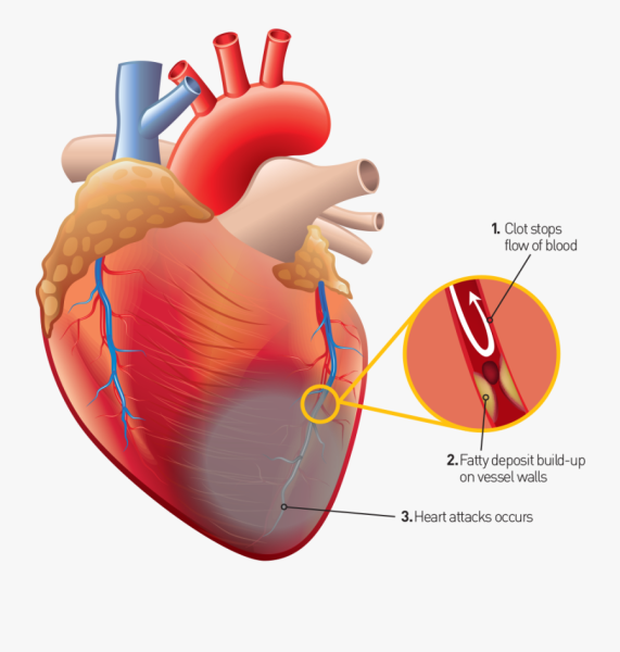 Первичный инфаркт миокарда