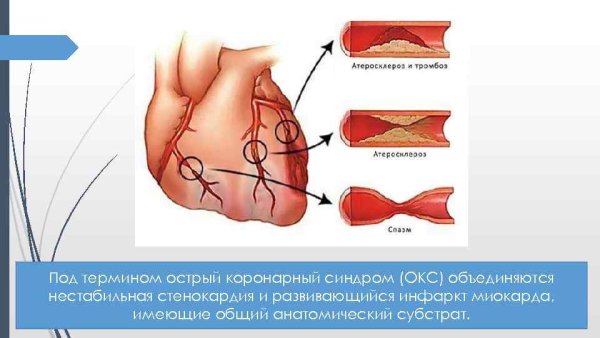 Острый коронарный инфаркт