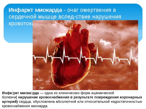 Гемопиаркад острого инфаркта миокарда