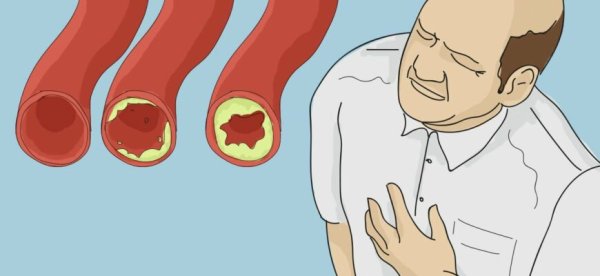 Профилактика инфаркта