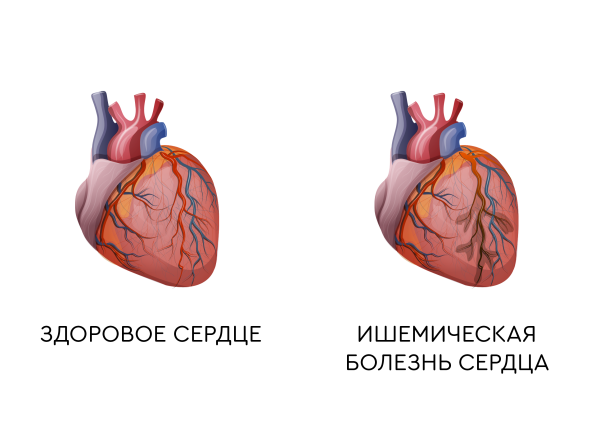 Ишемическая болезнь сердца инфаркт миокарда