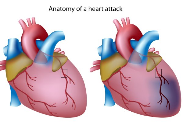 Сердце анатомия инфаркт