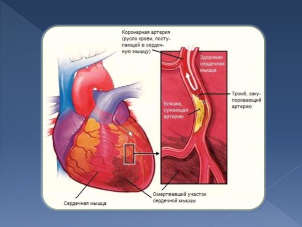 Левожелудочковый инфаркт миокарда