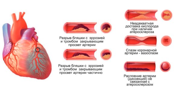Стадии развития инфаркта миокарда патанатомия