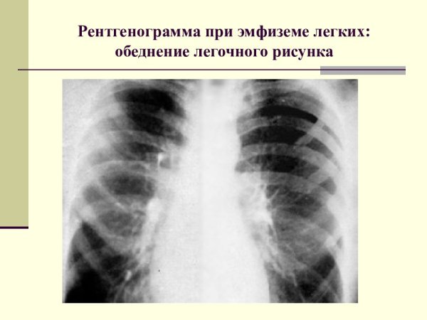 Обеднение легочного рисунка рентген