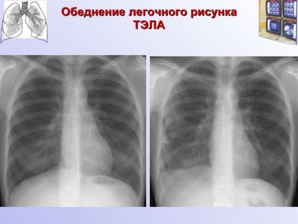Обеднение легочного рисунка на рентгенограмме