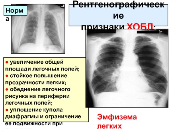 Распространенное обеднение легочного рисунка возникает при